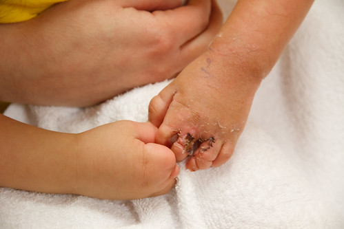 Amelie's Cast comes off