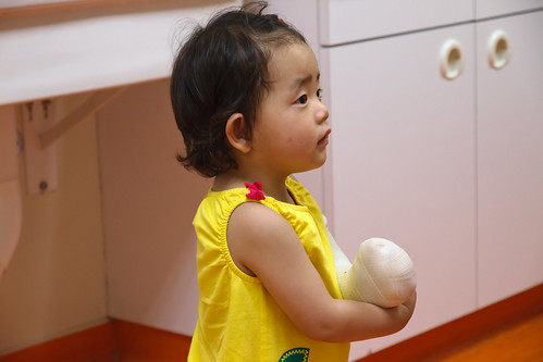 Amelie's Cast comes off